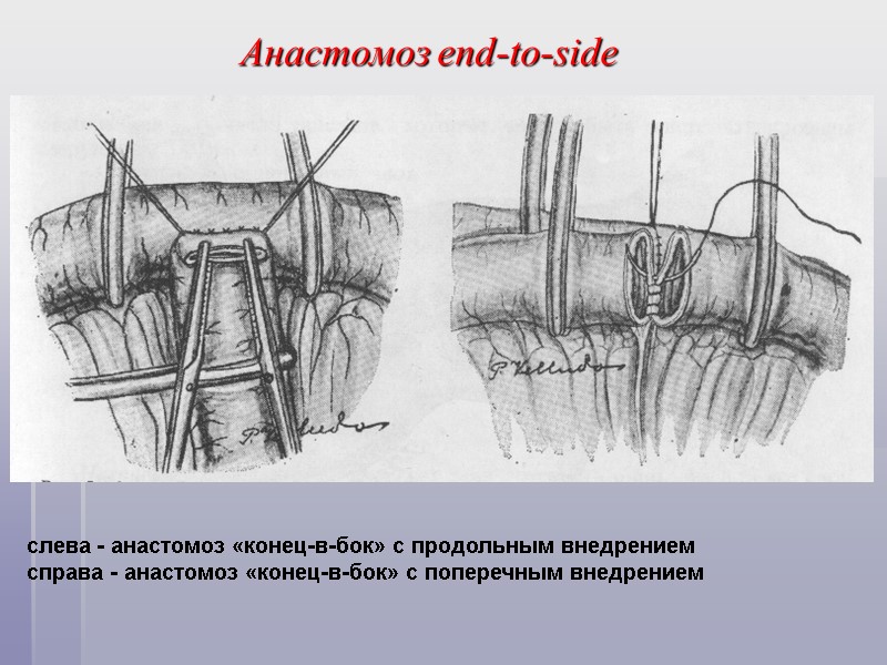 Анастомоз end-to-side слева - анастомоз «конец-в-бок» с продольным внедрением справа - анастомоз «конец-в-бок» с